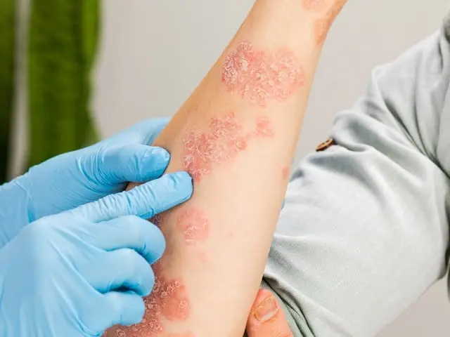 How Does a Dermatologist Diagnose Rashes, Allergies, or Itching? How Does a Dermatologist Diagnose Rashes, Allergies, or Itching