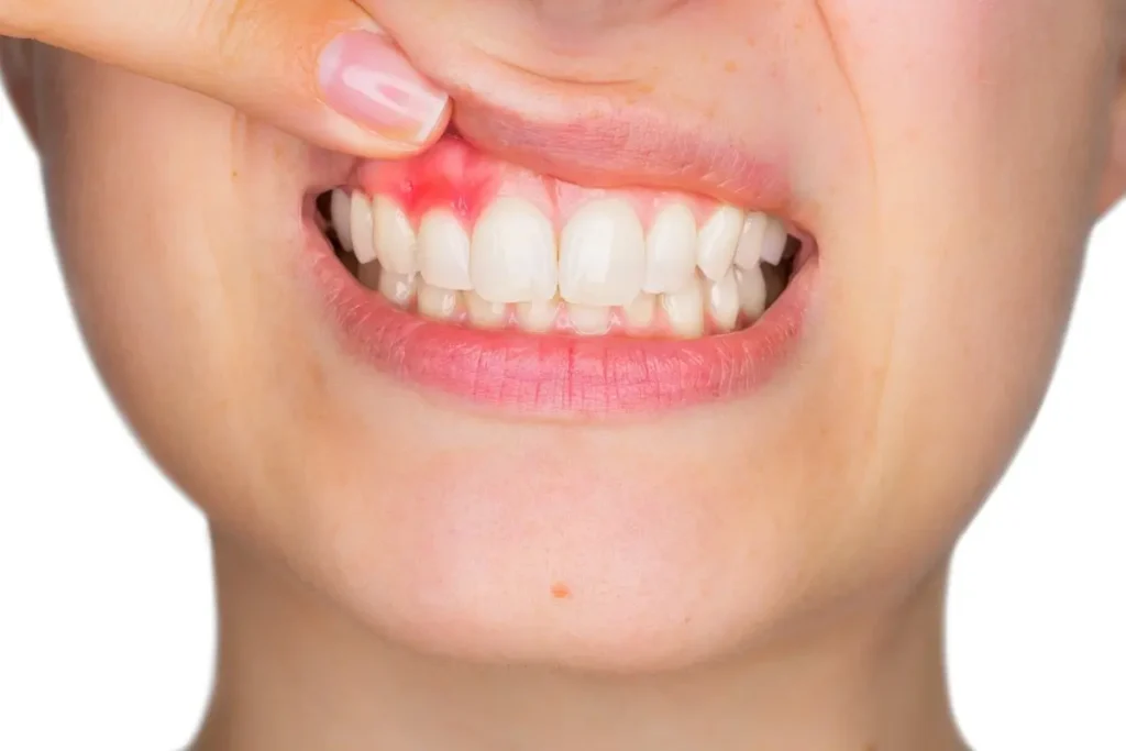 Why You Should Be Concerned About Gums That Recede Over Time